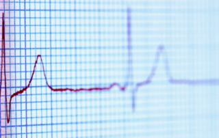 societies detail treatment for patients with ventricular arrhythmmias