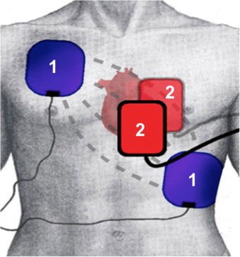 Double sequential defibrillation