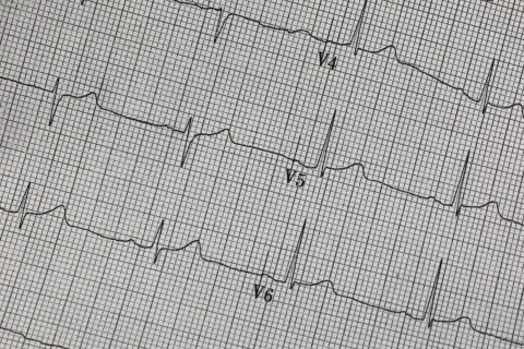 ECG