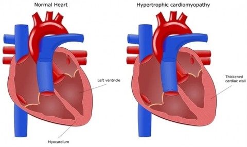 HCM