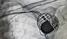 image of ICD
