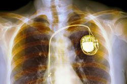 xray of chest with pacemaker