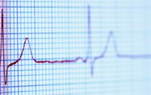 societies detail treatment for patients with ventricular arrhythmmias