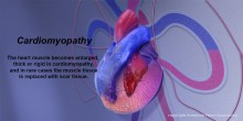 Cardiomyopathy