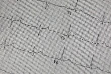 ECG