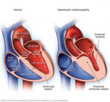 graphic of hypertrophic cardiomyopathy
