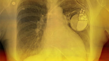 ICD Implant