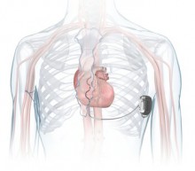 Medtronic EV ICD illustration in chest