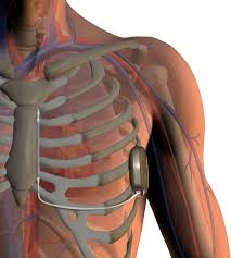 S-ICD