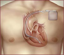 ICD placement